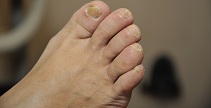 toenail fungus treatment