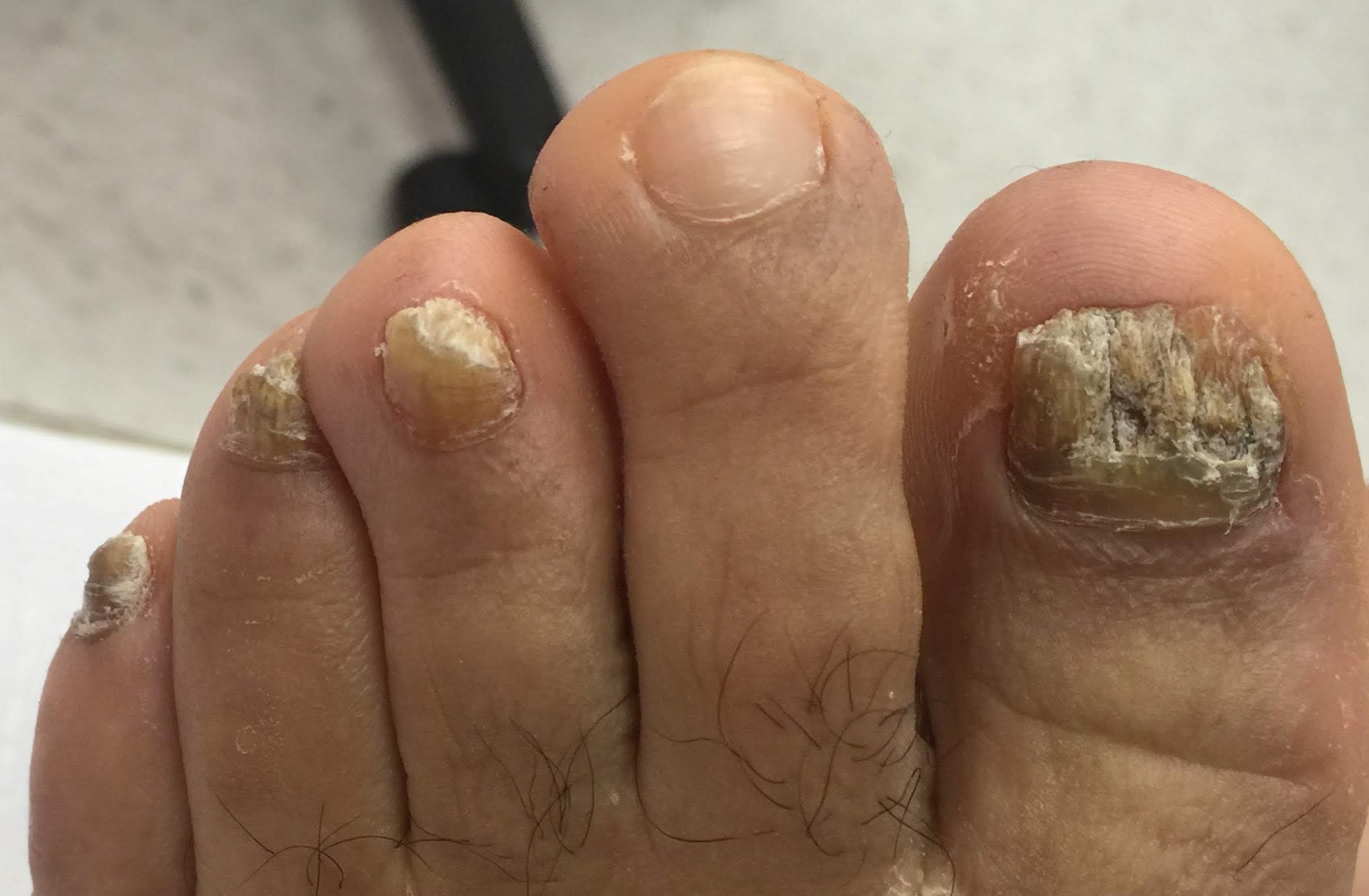 About Toenail Fungus. Before and After Images