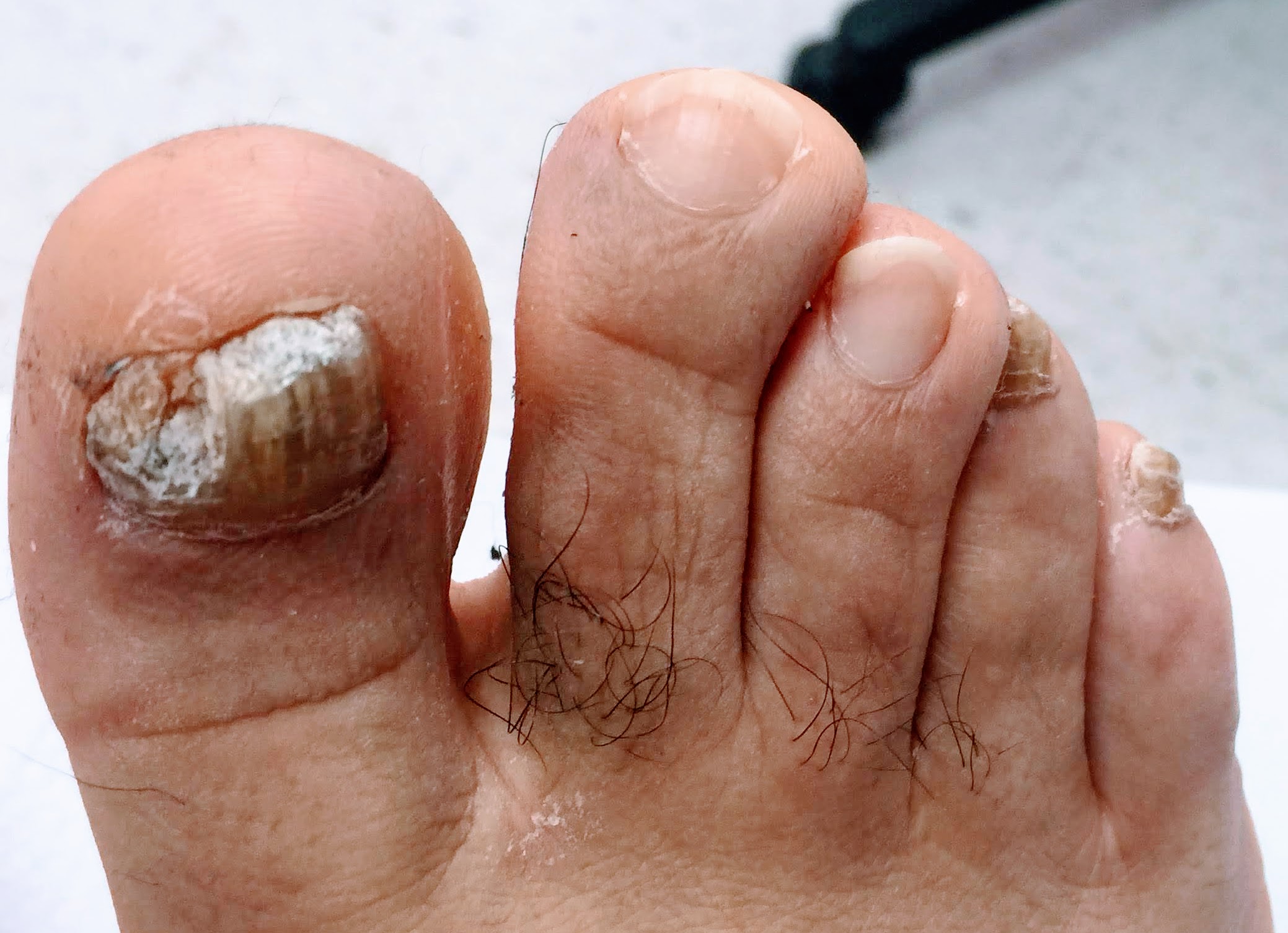 toenail fungus treatment